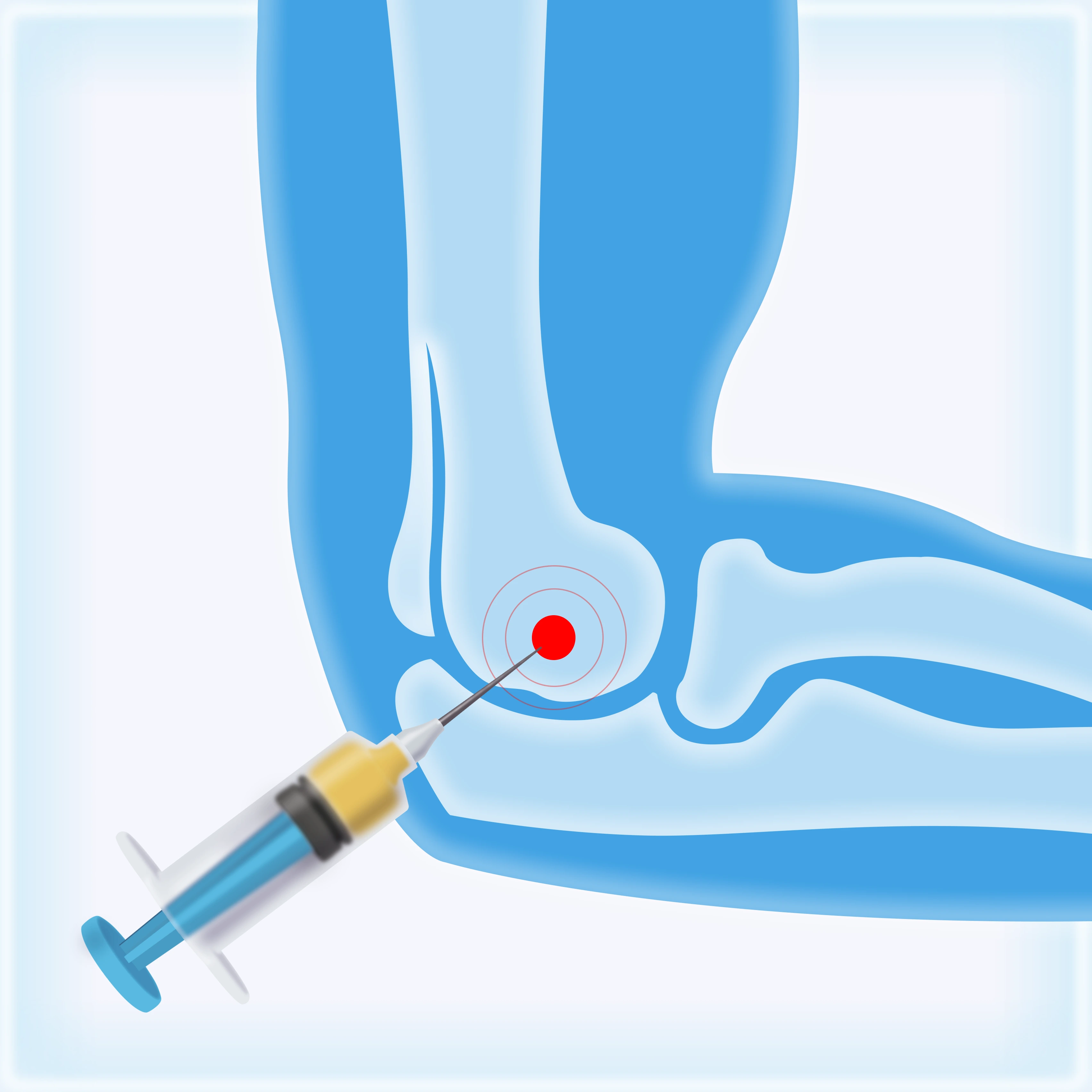 PRP Therapy for Tendonitis